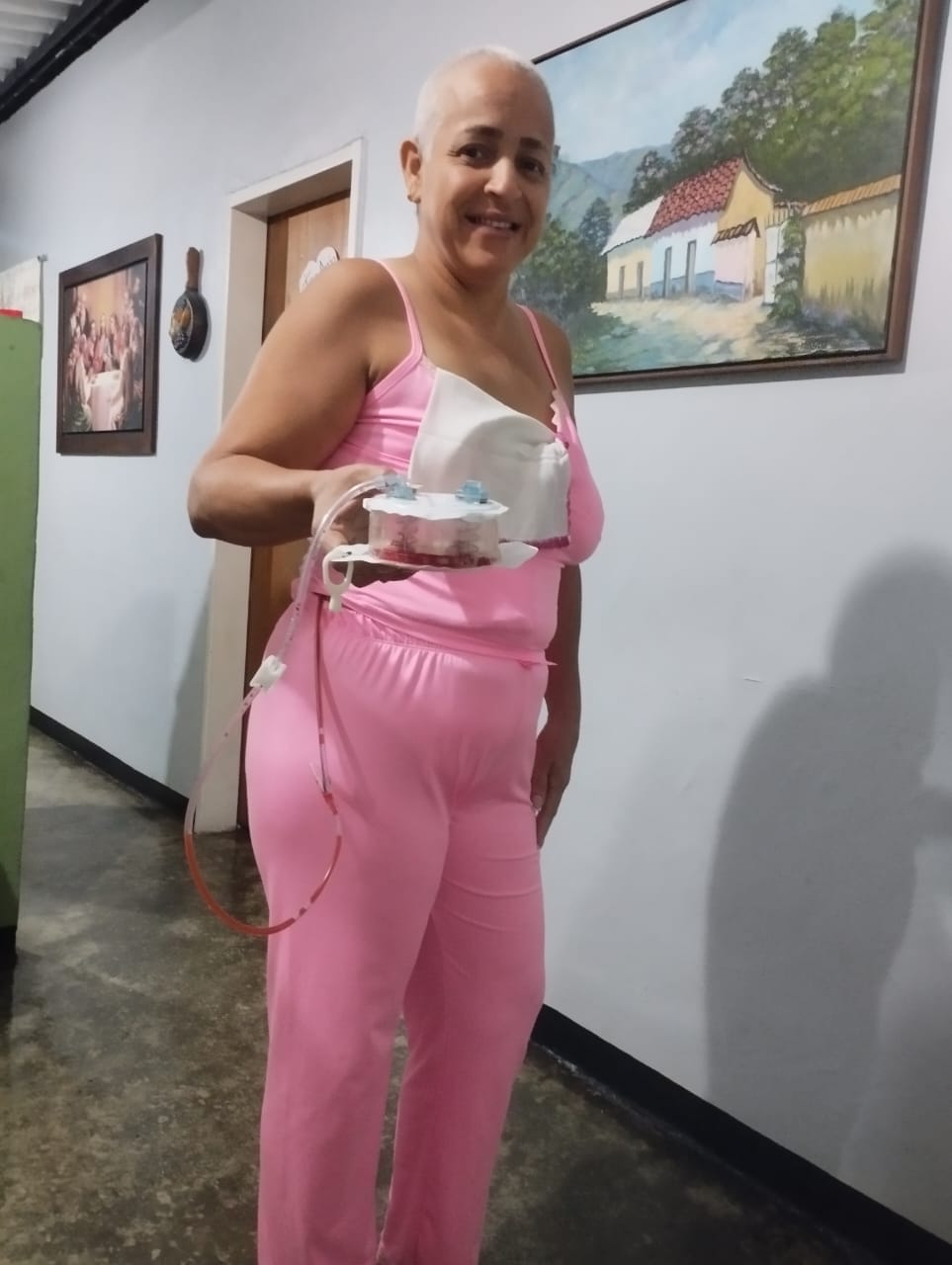 Yamilet Díaz, after surgery to remove a breast because of cancer.